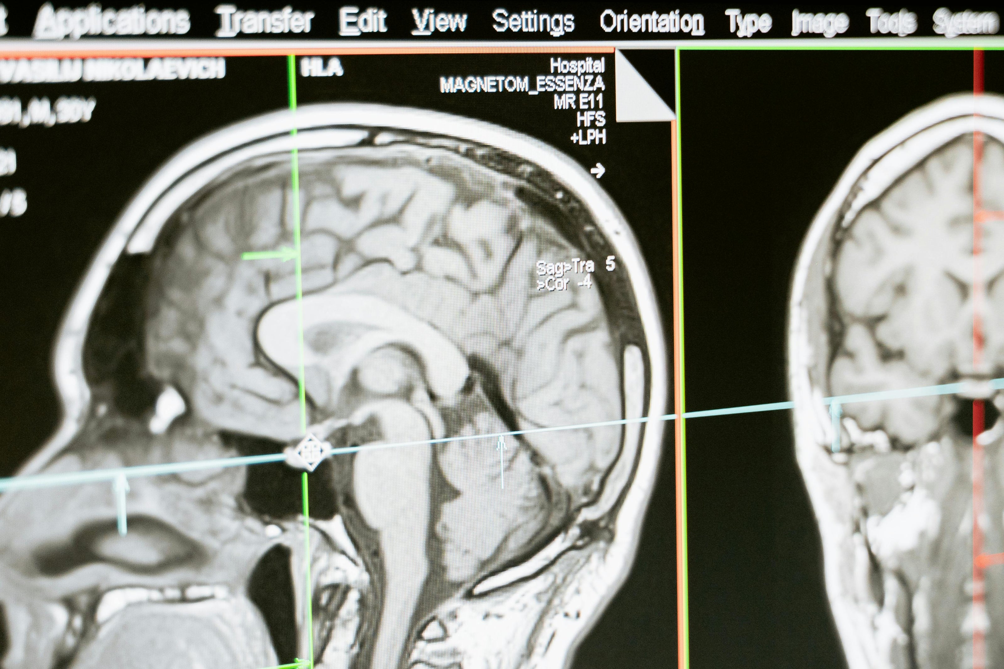 Brain Scan MRI Mart Production
